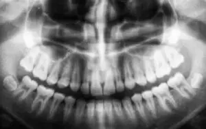 xray of teeth