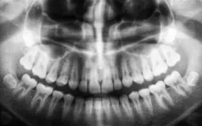 xray of teeth