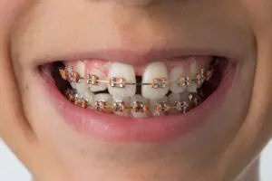 Wheaton, IL, dentist offers orthodontic treatment 